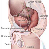 Prostate Cancer Prostate Gland Operation