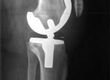 My Knee Replacement Went Wrong: A Case Study