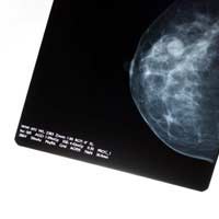 Mastectomy Lumpectomy Breast Cancer