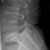 I Had My Spine Fused: A Case Study