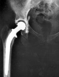 Hip Replacement Arthritis Joints
