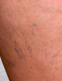 Varicose Vein Stripping Varicose Vein