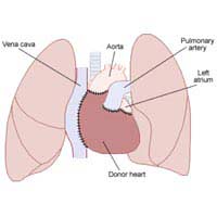 Heart Transplant Heart And Lung