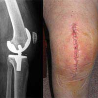 Knee Replacement Surgery Hip Replacement